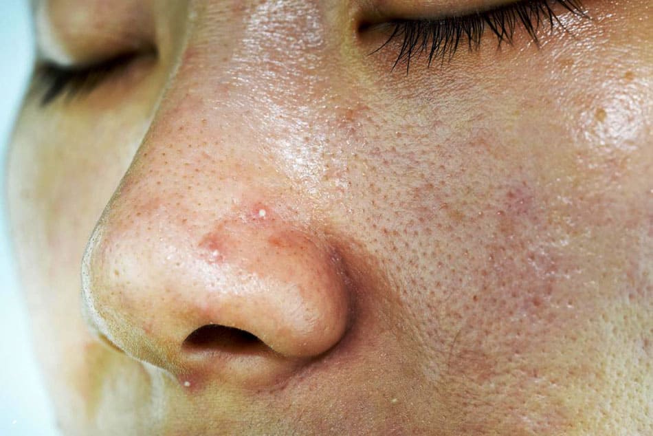 cushion danh cho da dau nhay cam giup kiem soat dau va kich ung